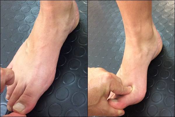 Test de Jack con resultado negativo. Observa como aumenta El arco plantar medial y la tibia rota externamente.