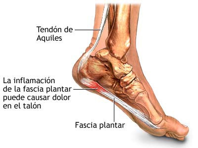 tratamientos fascitis plantar