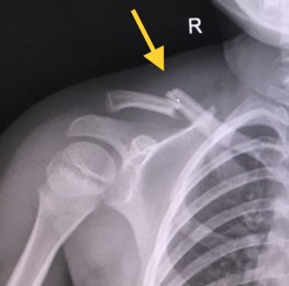 rotura de clavícula en niños