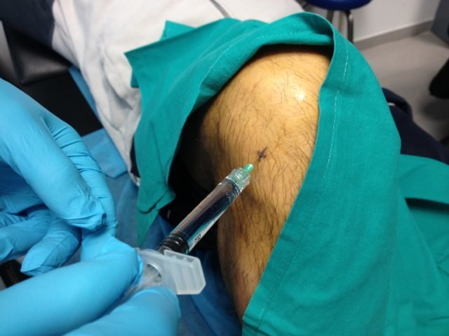 Ácido hialurónico: busca “lubricar” la rodilla y con esta actuación disminuir el dolor. 