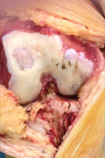 Artrosis dolor de rodilla