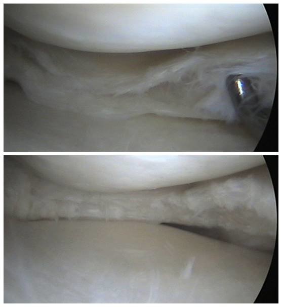 Dolor de rodilla menisco 