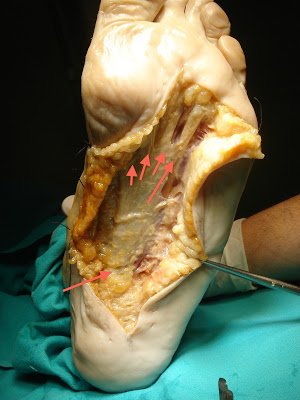 fascitis plantar dolor talon