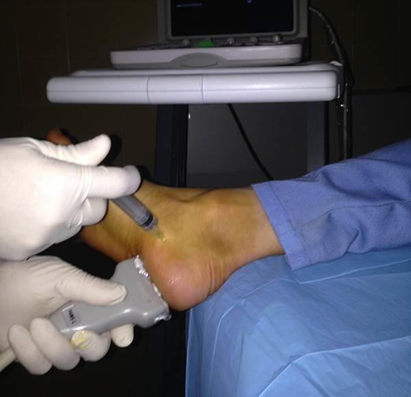 infiltracion talon fascitis