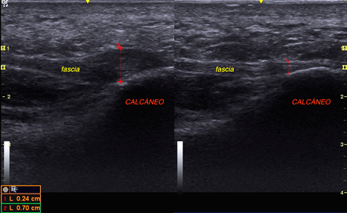 Vista ecográfica de una fascia plantar normal (Derecha) y una con fasciosis crónica (Izquierda). Se ve el aumento de grosor de la fascia dañada (0,7 cm) respecto a la sana (0,24 cm)