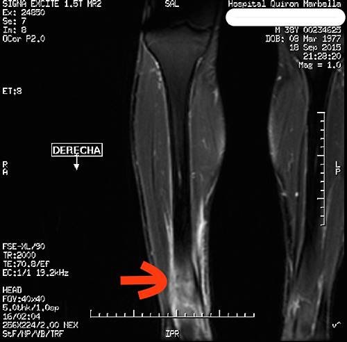 TAC de una fractura por stress en tibia derecha (flecha roja)