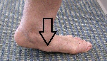 colapso fascitis plantar