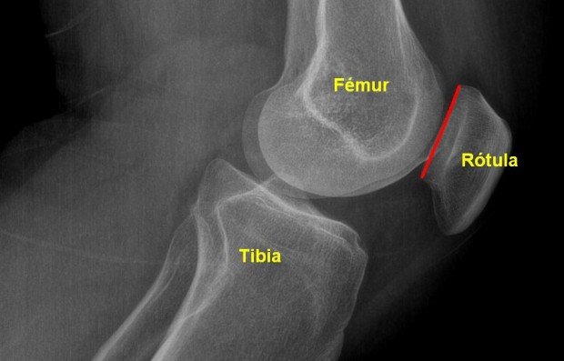 dolor detras rodilla