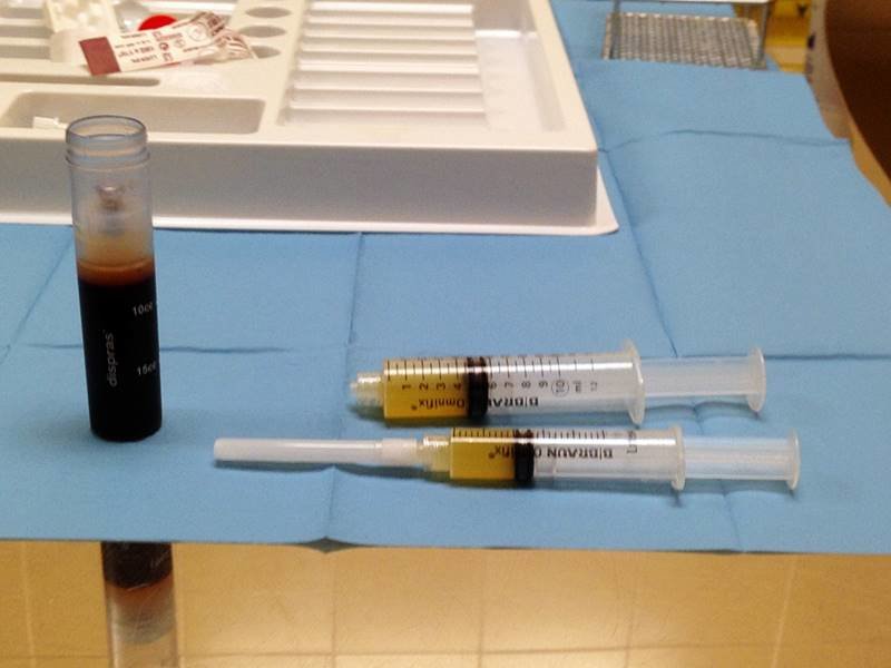 infiltraciones plasma rico en plaquetas