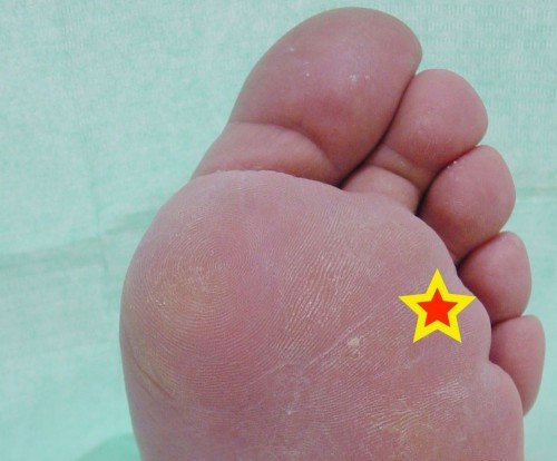 Neuroma de morton