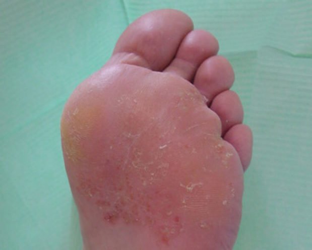 tratamiento hongos en los pies