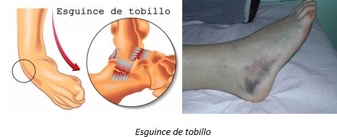 esguince de tobillo