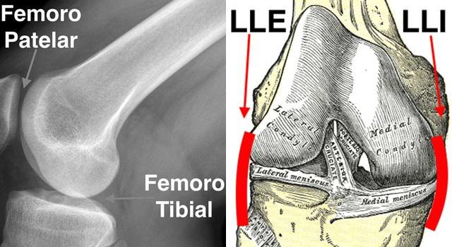 esguince de rodilla ligamento lateral interno