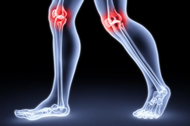 El síndrome de dolor patelofemoral
