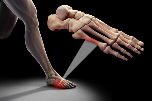 Metatarsalgia: dolor en zona metatarso del pie